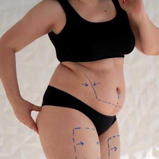 Liposuction in Riyadh